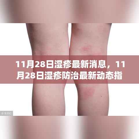 11月28日湿疹防治最新动态指南,全面管理湿疹,掌握应对技能