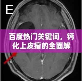 百度热门关键词,钙化上皮瘤的全面解析——从了解、诊断到治疗